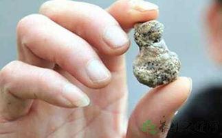 肾结石可以吃洋瓜吃